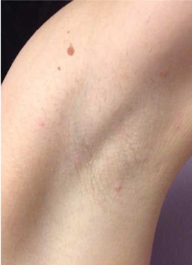 After treatment