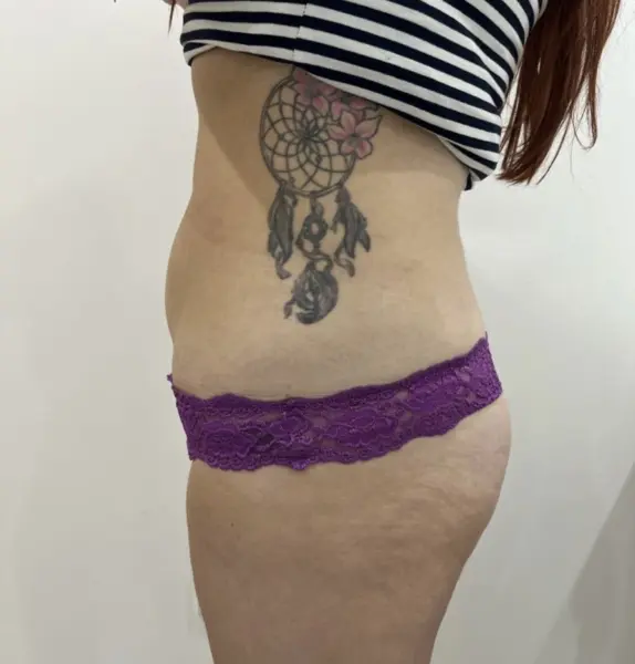 After treatment